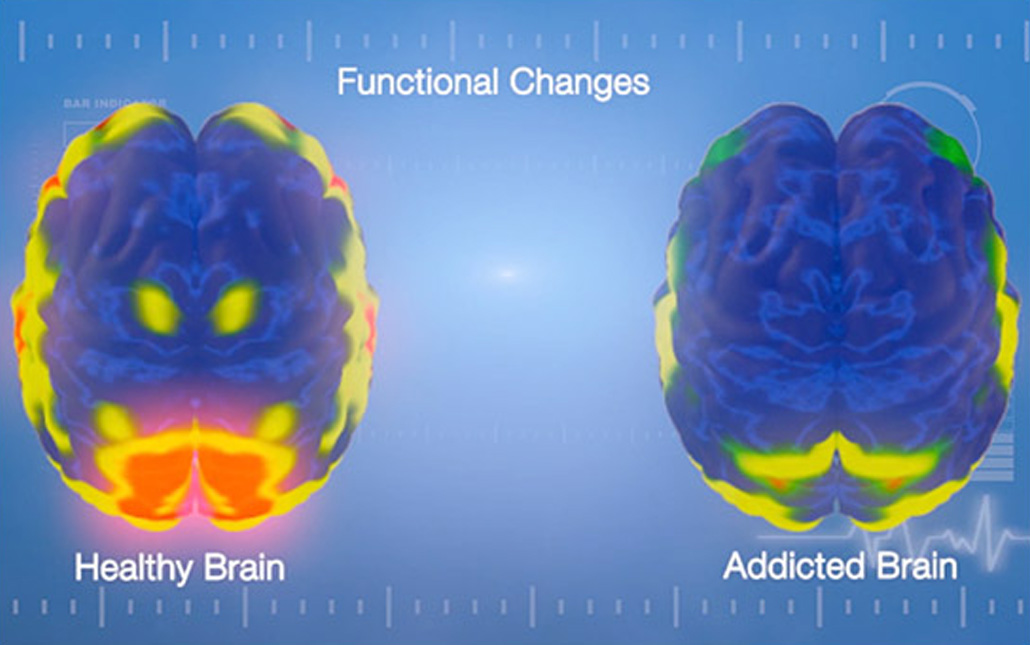 Мозг терапия япония. Мозг алкоголика и наркомана. Головной мозг наркомана фото.